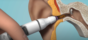 EarWay - Superior earwax removal at home